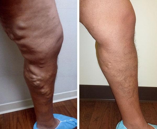 Varicose Veins Treatment - Before and After 1