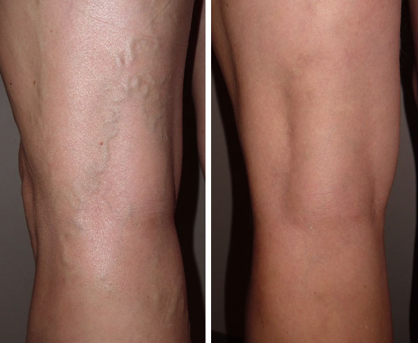Varicose Veins Treatment - Before and After 2