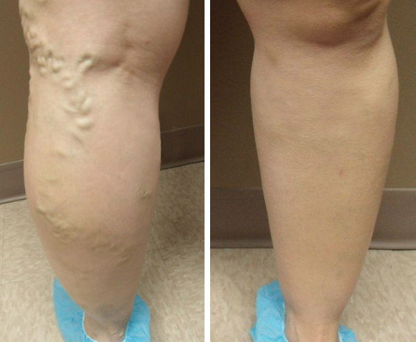 Varicose Veins Treatment - Before and After 3