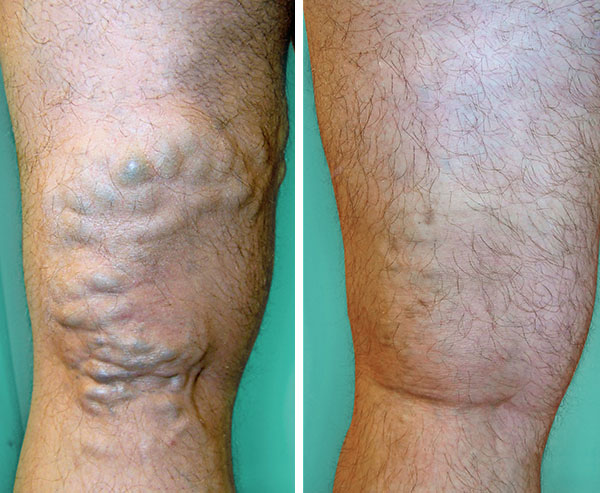 Varicose Veins Treatment - Before and After 4