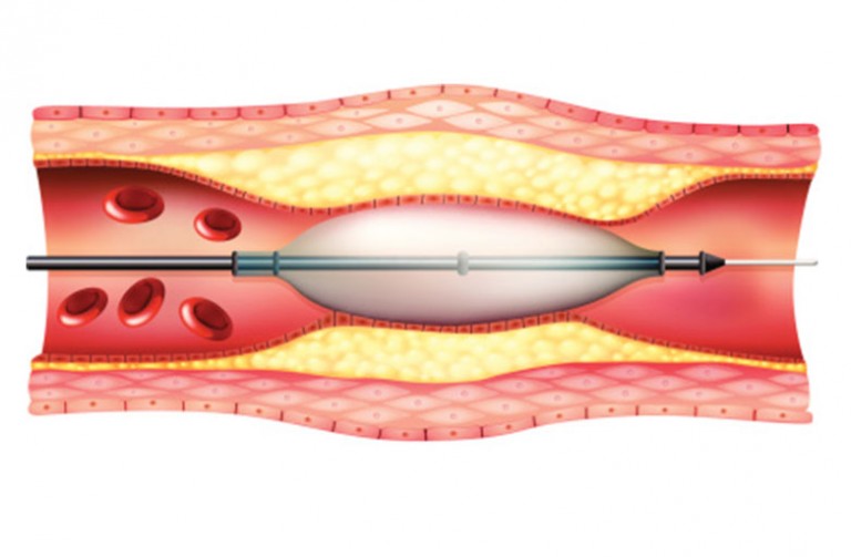 dallas-angioplasty-and-stent-placement-peripheral-angioplasty