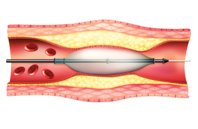 angioplasty-and-stenting