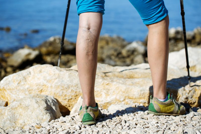 Woman with varicose veins