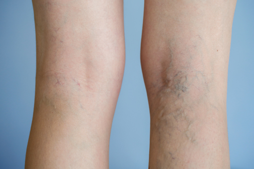 varicose veins more than a cosmetic concern