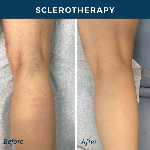 sclerotherapy before and after back