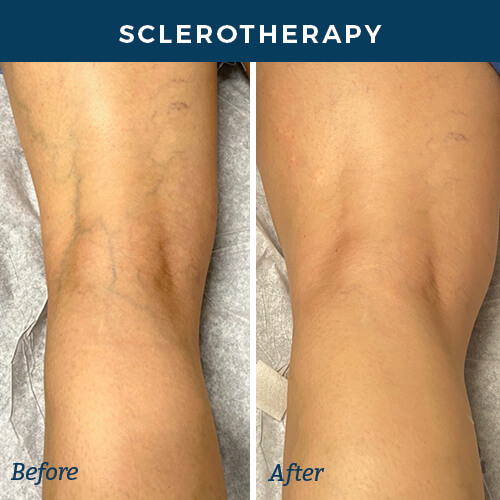 sclerotherapy before and after back