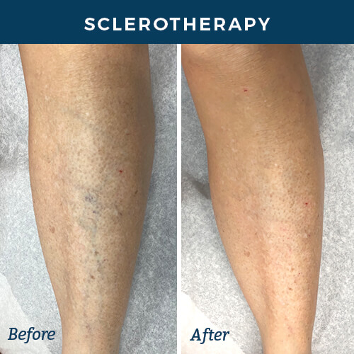 sclerotherapy before and after front